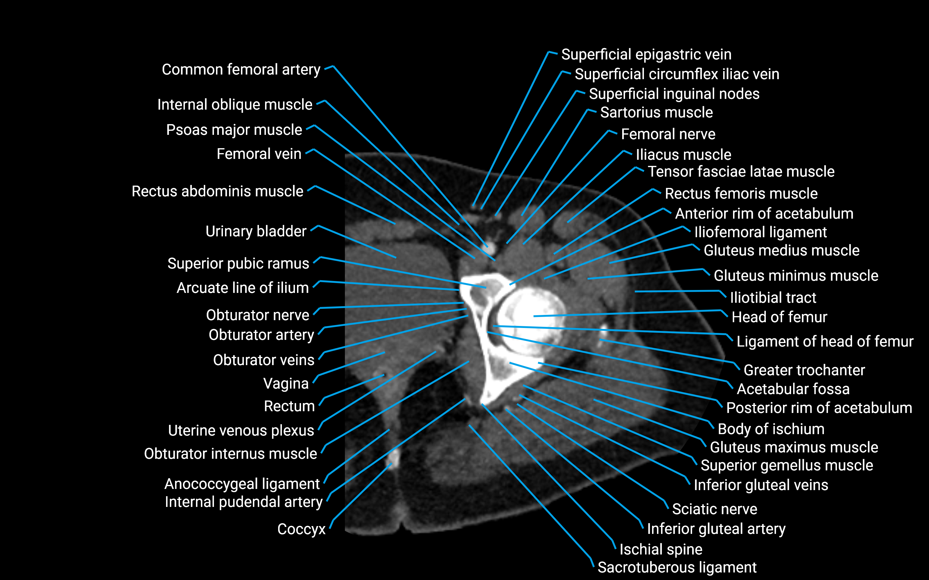 CT Hip axial cross sectional anatomy labelled image 7 (1).png